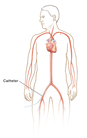 Outline of male figure showing transfemoral cardiac catheterization.