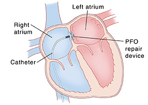 Cross section of heart showing four chambers and catheter inserting a patent foramen ovale closure device.